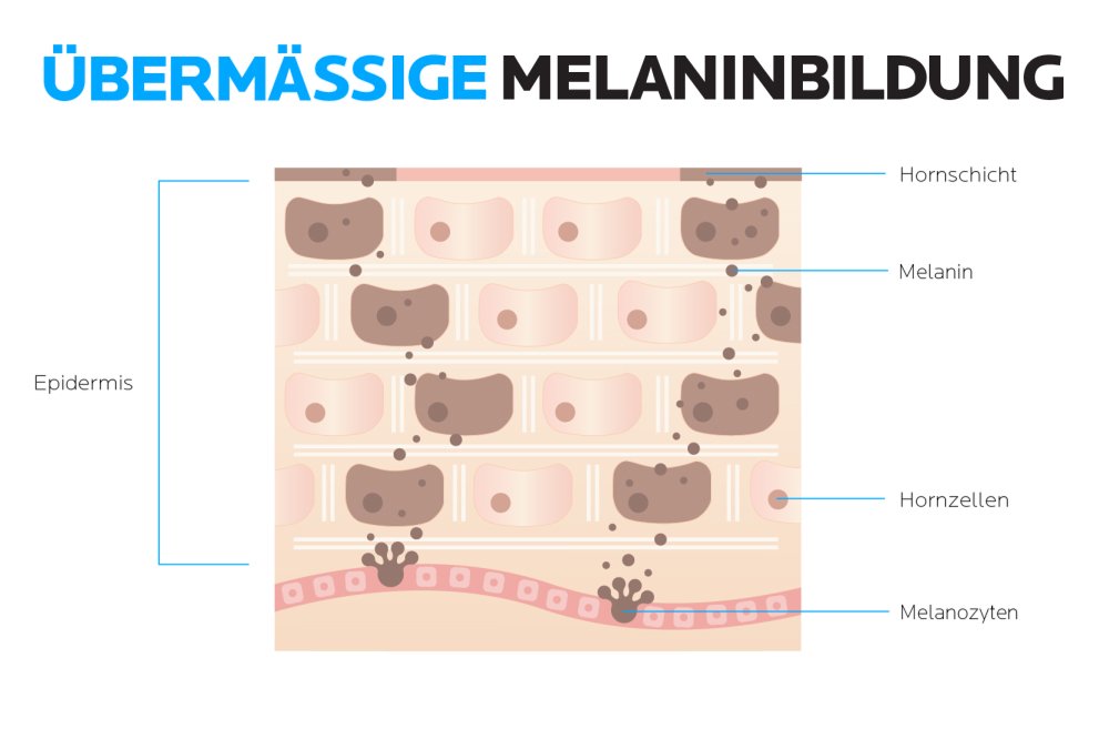 Grafik zur übermäßigen Melaninbildung in der Haut.