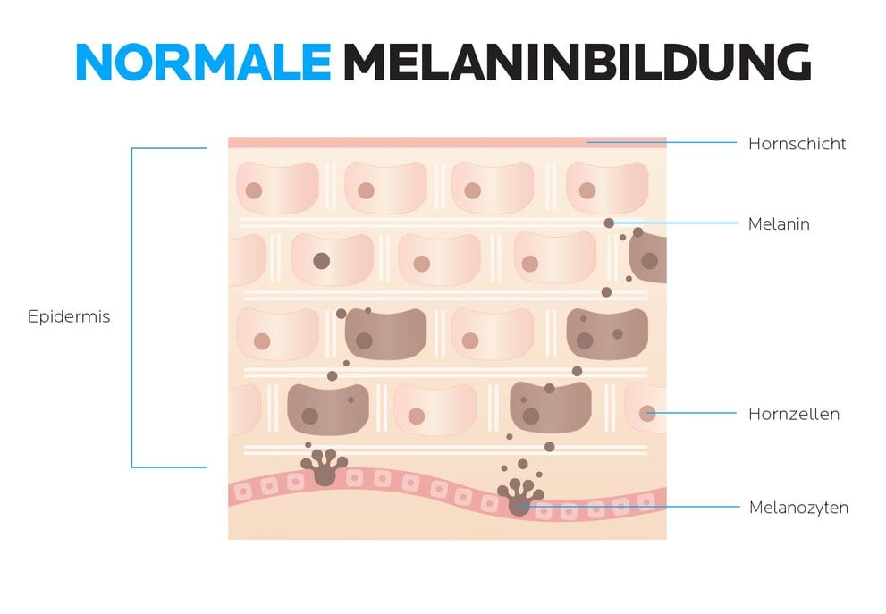 Grafik zur normalen Melaninbildung in der Haut.