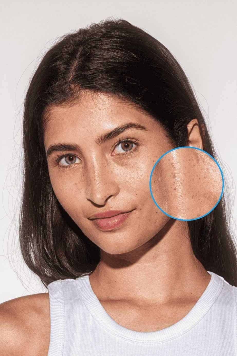 Braune Flecken im Gesicht einer jungen Frau