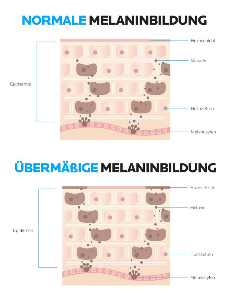 Vergleichsbild normale Melaninbildung und erhöhte Melaninbildung in der Haut während der Schwangerschaft